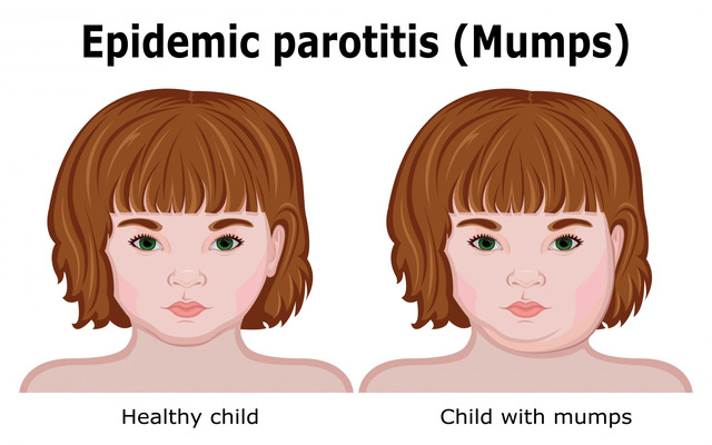  Signs and symptoms of mumps