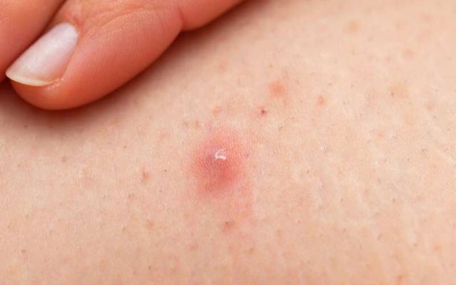  Folliculitis is among the summer skin concerns