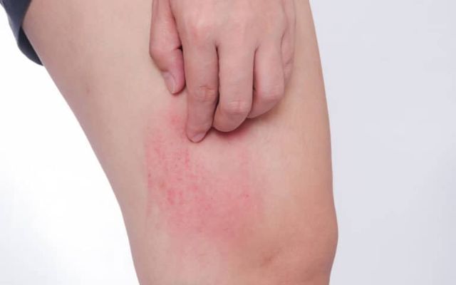 Chafing is one of the skin problems during summer