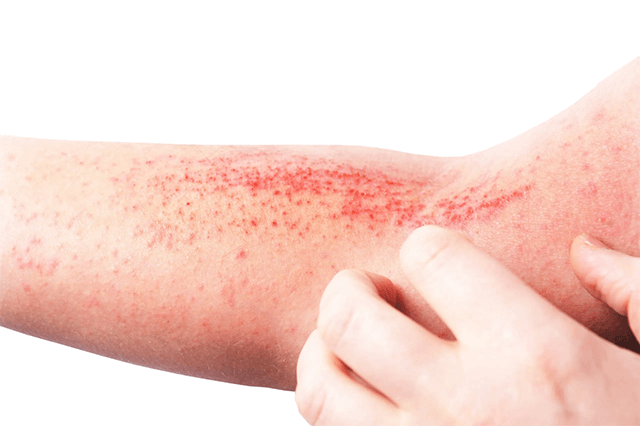 skin diseases in summer season