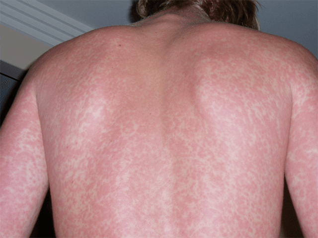skin diseases in summer season