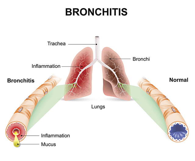 winter season diseases 