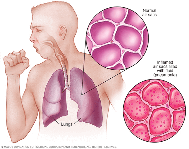 winter season diseases 